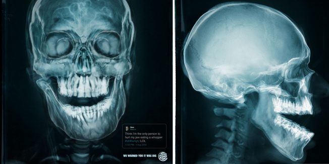 An X-ray of a jaw injured by eating a Whopper is shown.