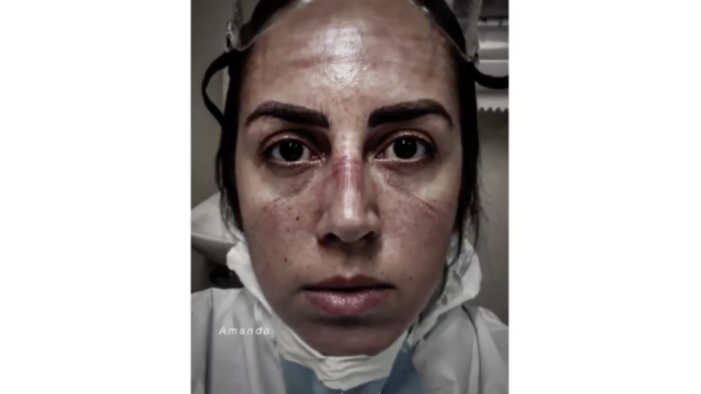 A closeup of a woman with PPE indents on her face.